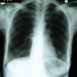 case2xray1
