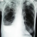 case2xray2