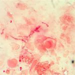 cornealscrape1