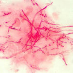 cornealscrape3