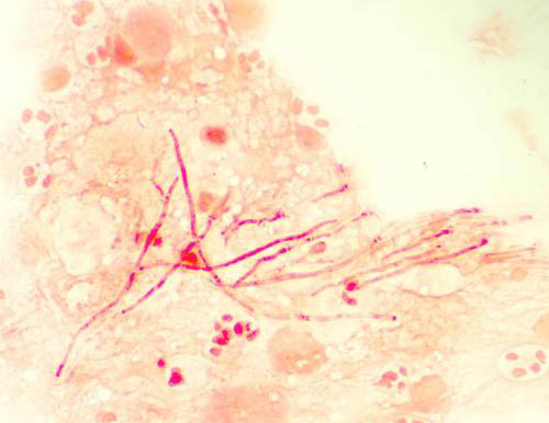 cornealscrape