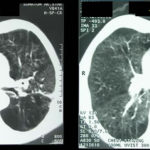 ctscan1