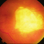 endopthalmitis