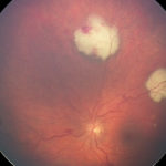 endopthalmitisleftRW
