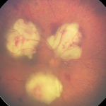 endopthalmitisrightRW