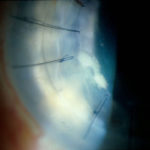 eye10AT