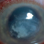 eye11AT