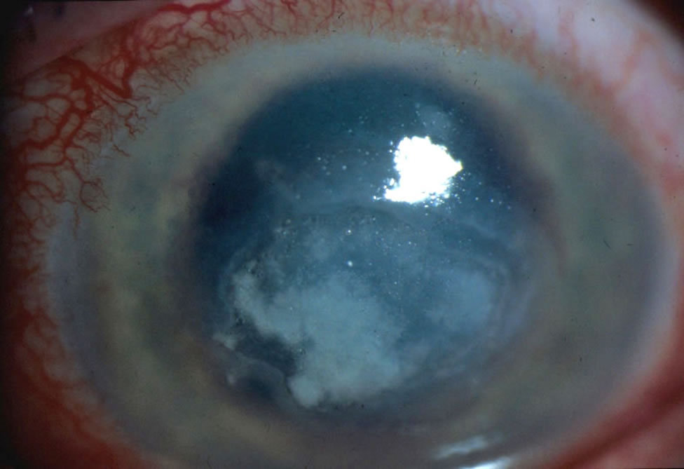 eye11AT