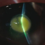 eye13AT