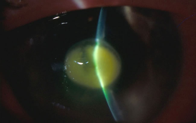 eye13AT