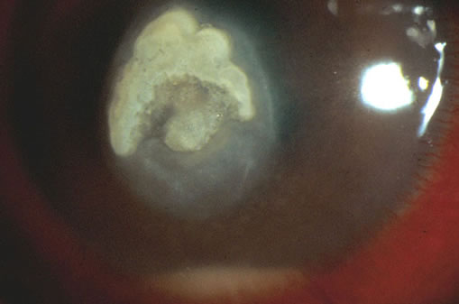 eye15AT