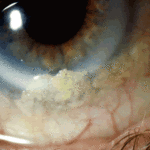 eye5ATullo