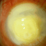 eye6ATullo