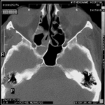 A - The right sphenoid sinus is opacified and there is some involvement of the right ethmoids. Bony structures seem intact.