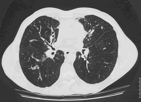 Image A. Patient with longstanding ABPA, showing some bronchiectasis in the right lung and considerable mucous plugging particularly around the main bronchi.