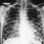 Image 1. Feb 8th Patient 20+ years, with CGD who presented breathless and coughing up purulent sputum.