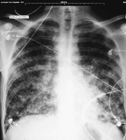 Image 1. Feb 8th Patient 20+ years, with CGD who presented breathless and coughing up purulent sputum.