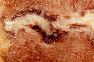 lumbardisc