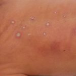 Image A . Multiple circular papules with white eschars on the back.