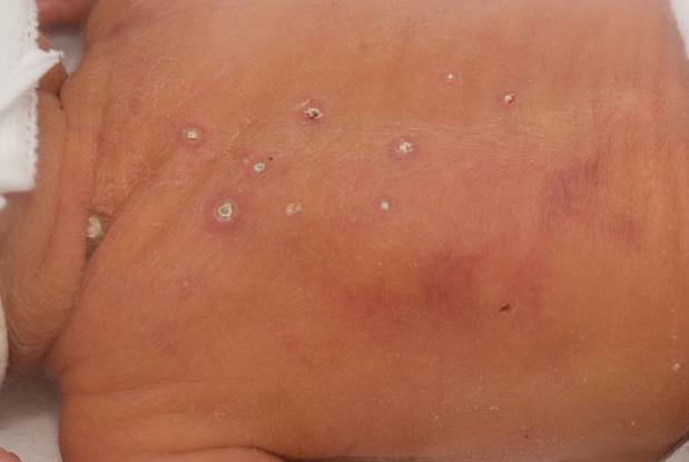 Image A . Multiple circular papules with white eschars on the back.
