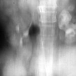 This diabetic patient underwent pyelolithotomy in India. Subsequently she presented with loin pain and passed fungal balls per urethra.