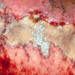 Close-up image of the lesion on the left thigh showing a mat of hyphae over the wound. 