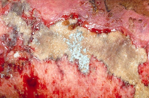 Close-up image of the lesion on the left thigh showing a mat of hyphae over the wound. 