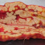 pengadrenal