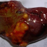 pengkidney