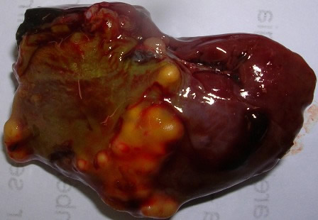 pengkidney