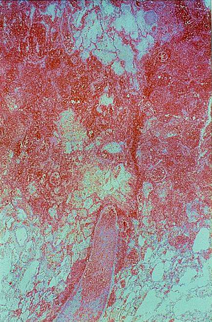 Invasive pulmonary aspergillosis. 