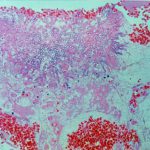 Pulmonary aspergillosis