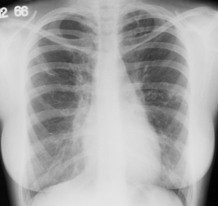 Image A. 13/12/66 Asthma.