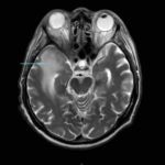 Image A. MRI (T2-weighted, transversal view).Note oedema of the right temporal lobe.