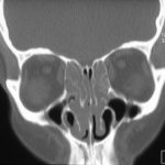 Patient AW Nasal polyposysis with asthma and sensitivity to aspergillus.
