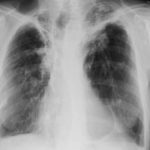 Chest X-ray 13/11/09 