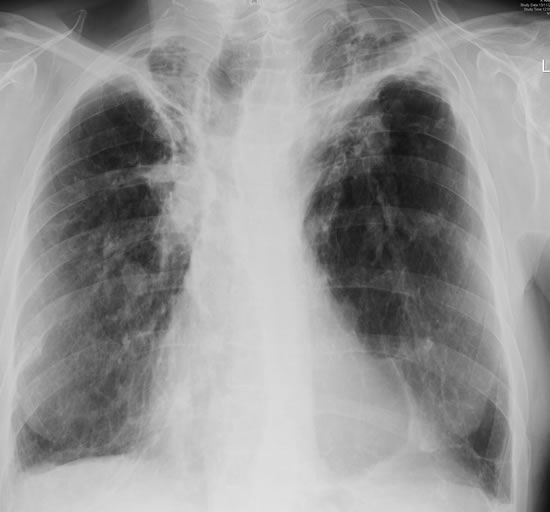 Chest X-ray 13/11/09 