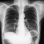 Normal x-ray from June 1999.