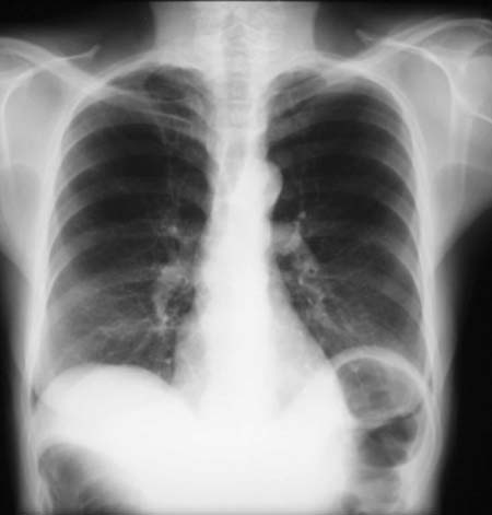 Normal x-ray from June 1999.