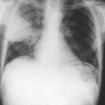 Chest X ray after 4 days, prior to treatment