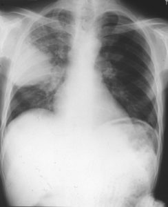 Chest X ray after 4 days, prior to treatment