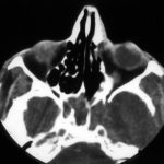 CT scan of the sinuses shows a completely opacified sphenoid sinus in this man with AIDS 