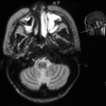 High intensity signal on the left on this MR scan on an allogeneic BMT patient with histologically proven Aspergillus sinusitis.