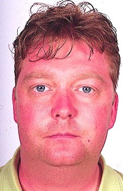 Facial erythema related to voriconazole