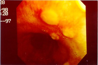 tracheal-3