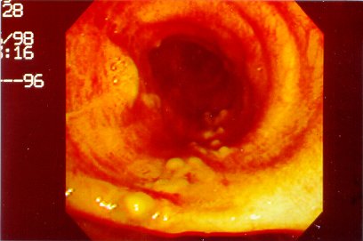 tracheal-4