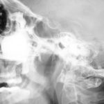 xray1