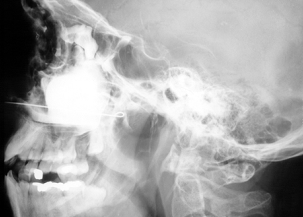 xray1