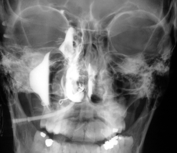 xray2