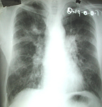 Chest x ray of patient one month prior to admission 